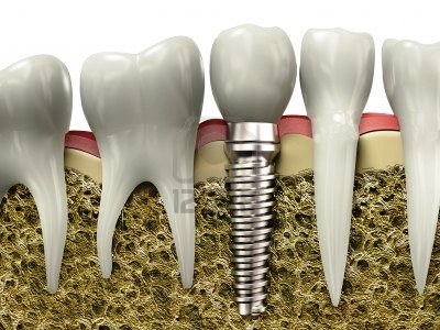 New tooth implant service at Dr Murthy’s dental clinic