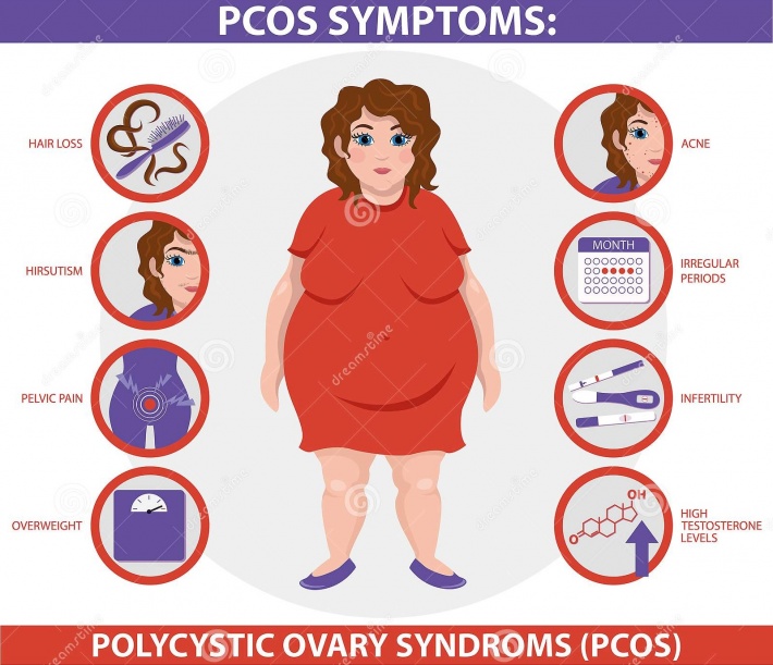 Understanding PCOS – the most common hormonal disorder among women of reproductive age