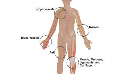 Sarcoma – the ‘forgotten cancer’
