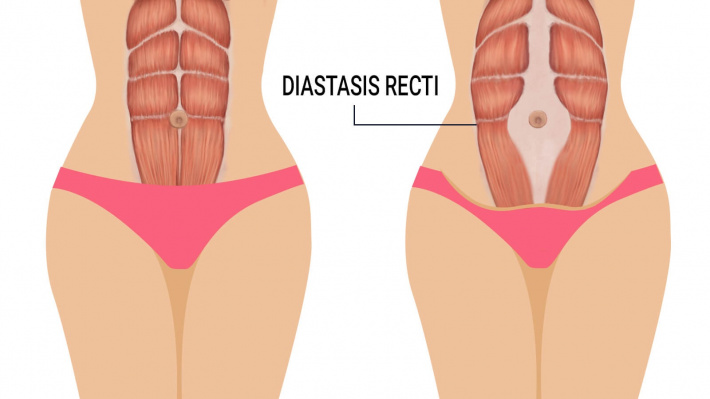 Understanding and promoting healing for Diastasis Recti