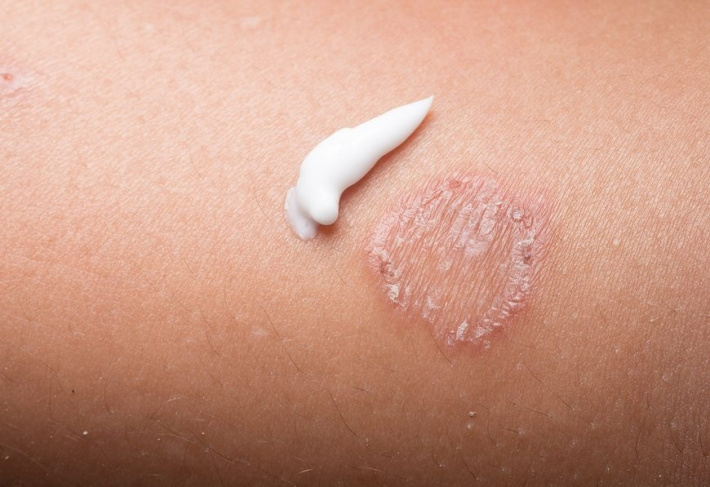 Pharmaceutical: Fungal skin infections & topical therapy