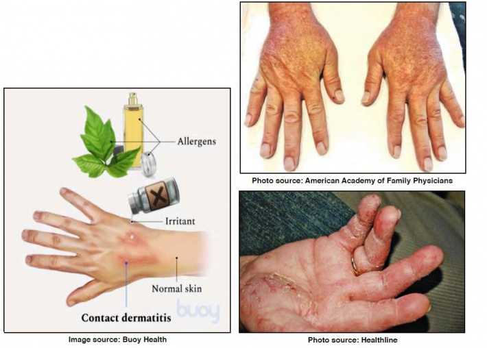 Pharmaceuticals: Over-the-counter remedies for hand dermatitis
