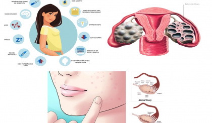 Gynaecology: Raising awareness of Polycystic Ovary Syndrome
