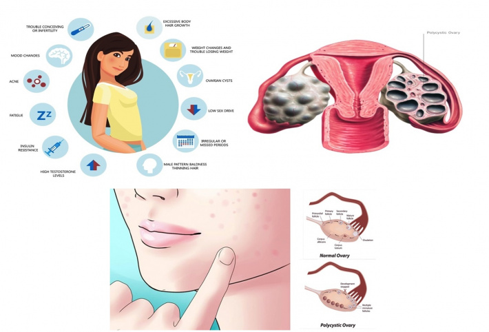 Gynaecology: Raising awareness of Polycystic Ovary Syndrome