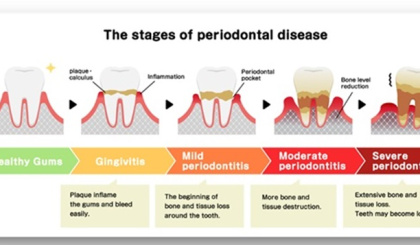 UNDERSTANDING THE IMPACT OF PERIODONTAL DISEASES ON GENERAL HEALTH